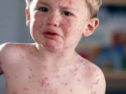 measles